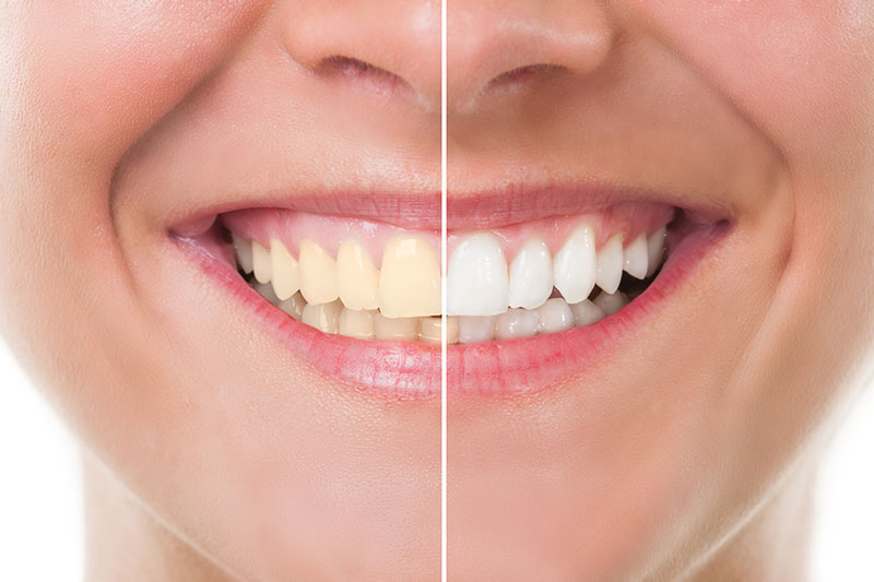 Teeth Whitening in Liberty Township